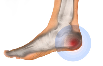 Heel pain sales plantar fasciitis strapping