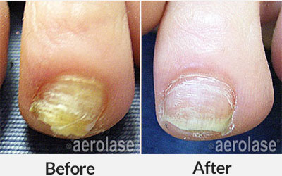 aerolase nails treatment