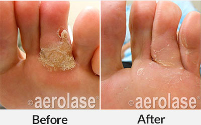 aerolase warts treatment