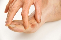 How Bunions Form