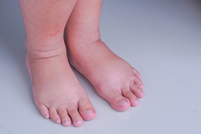 Common Causes of Swollen Feet
