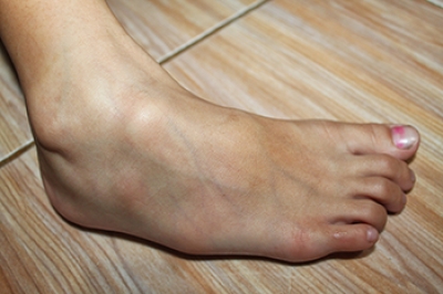 Dealing With Mallet Toe