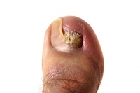 Strategies That May Help to Prevent Toenail Fungus