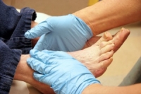 Diabetes and Its Impact on the Feet