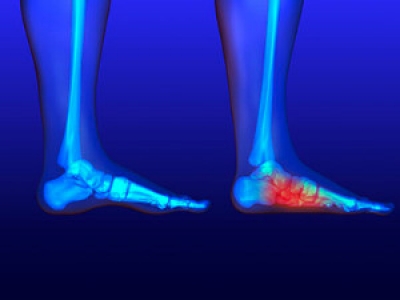 A Tell-Tale Symptom of Flat Feet