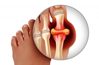 Symptoms That May Indicate Gout