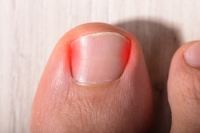 When To See a Podiatrist for Ingrown Toenails