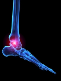 Rheumatoid Arthritis May Be Causing Your Ankle Pain