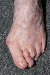 Bunions May Require Surgery