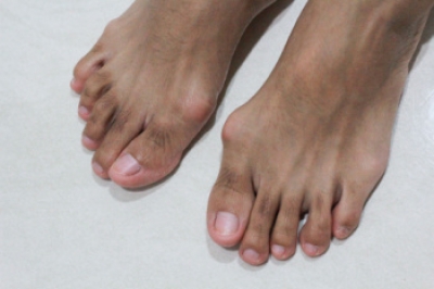 Recognizing Bunions as They Develop